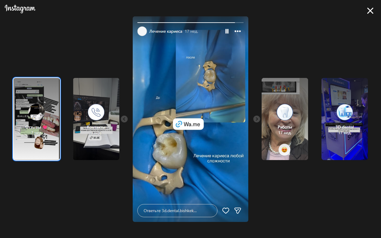 Лечение кариеса