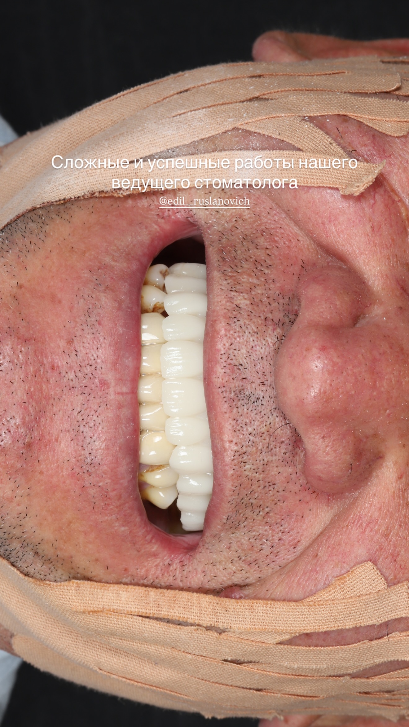 Коррекция прикуса